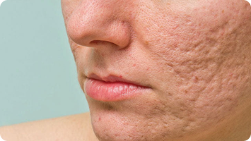 Scalp Micropigmentation