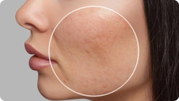 Scalp Micropigmentation